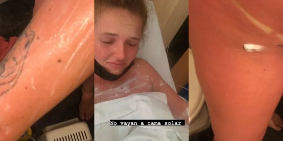 Aprovechó una promoción en cama solar y terminó con el 90% del cuerpo quemado